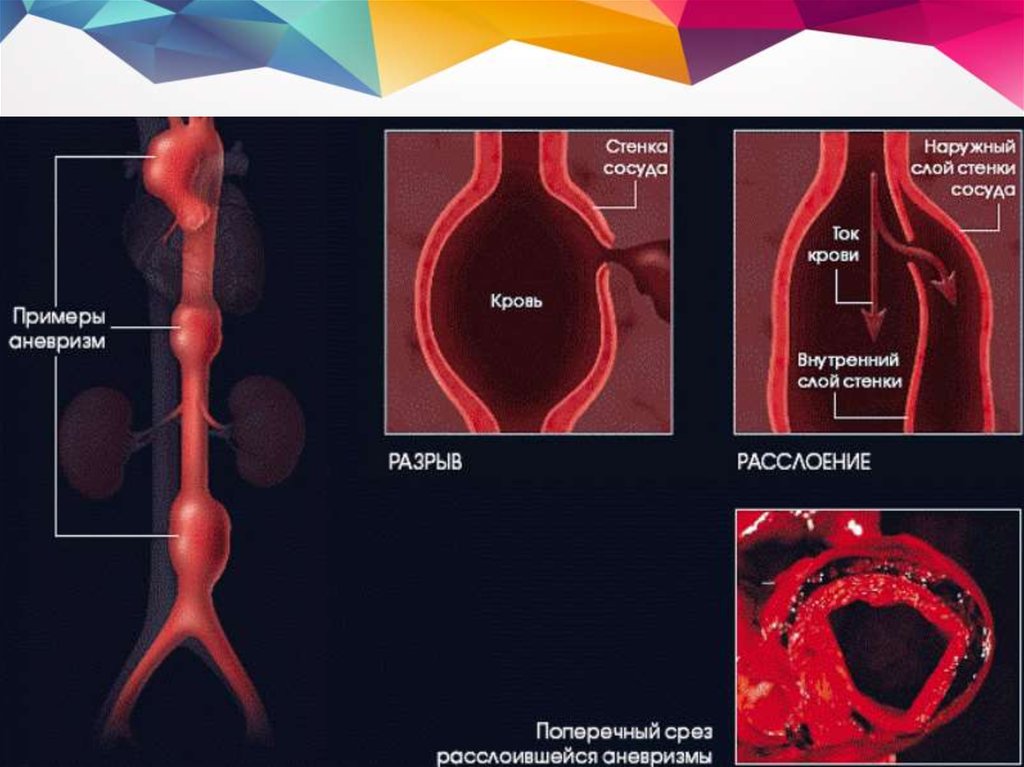 Аневризма аорты это. Расслоение аневризмы аорты клиника. Аневризма эктазия аорты. Аневризма брюшной аорты разрыв. Разрыв аневризмы грудной аорты.