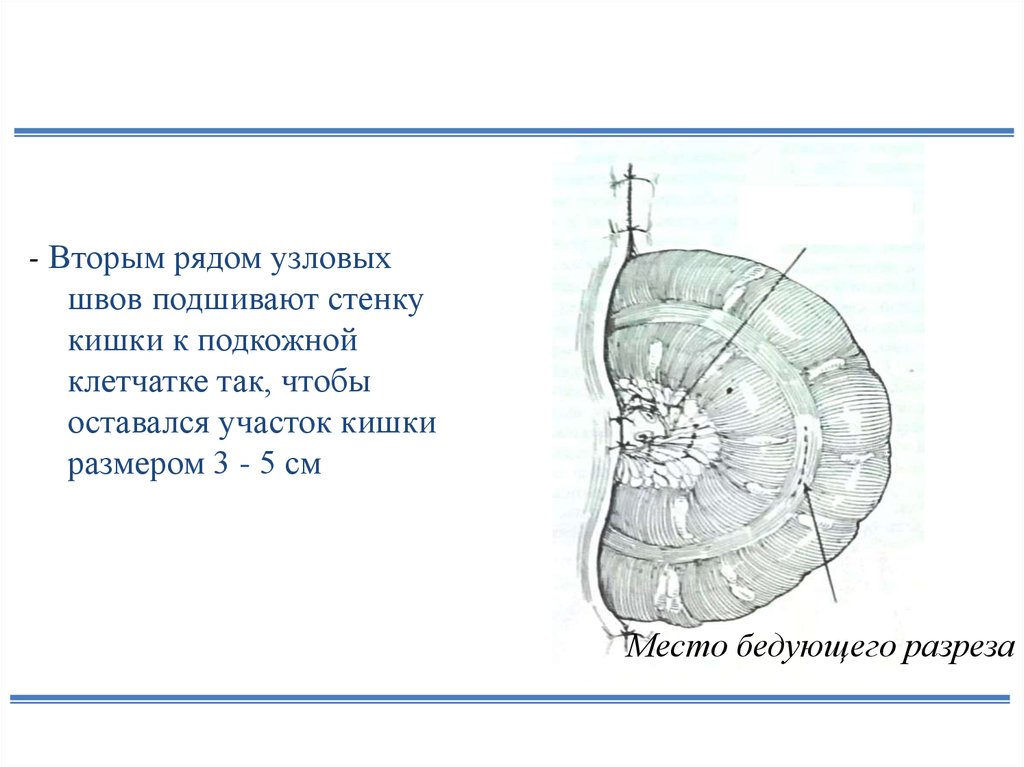 Колостома карта вызова