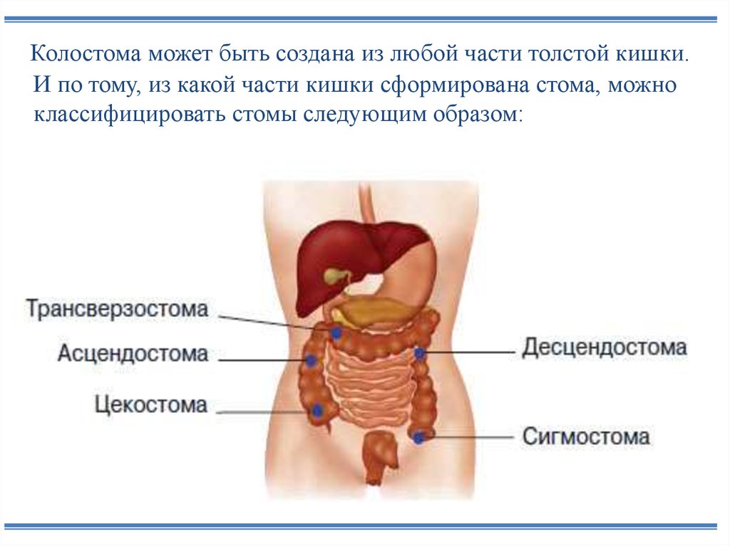 Стома стом. Трансверзостомия колостомия. Колостома трансверзостома. Классификация кишечных стом.