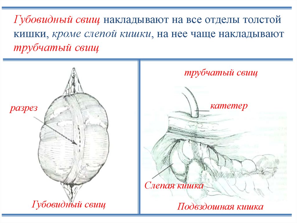 Выпадение колостомы карта вызова