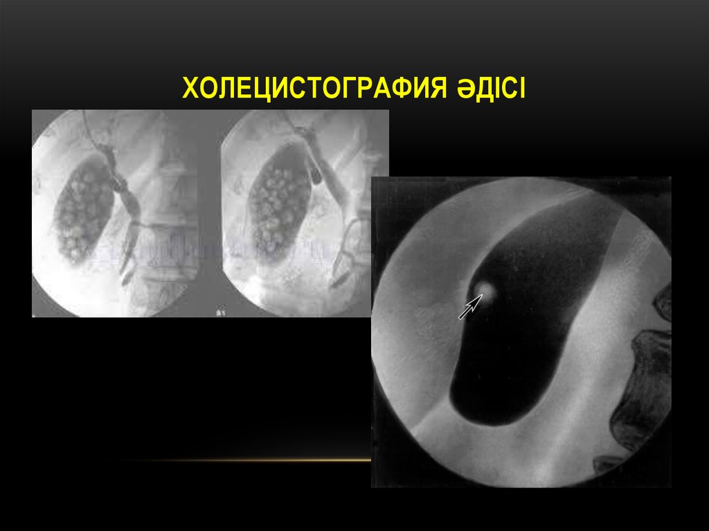 Пероральная холецистография