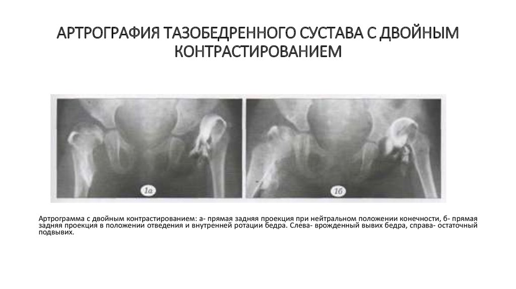 Вывих тазобедренного сустава карта вызова