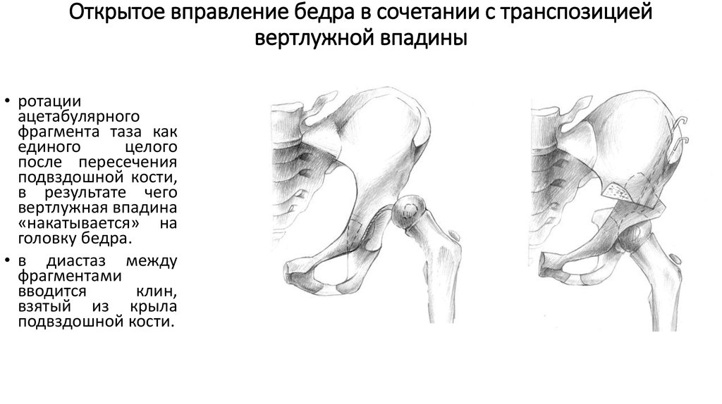 Перелом вертлужной впадины презентация