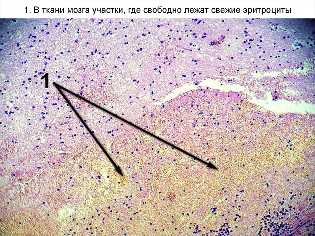 Кровоизлияние в мозг микроскопическая картина