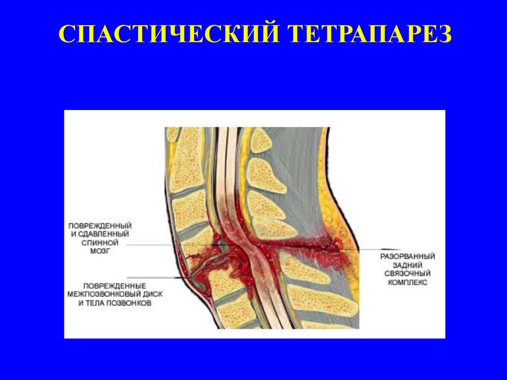 Центральный парез - презентация онлайн