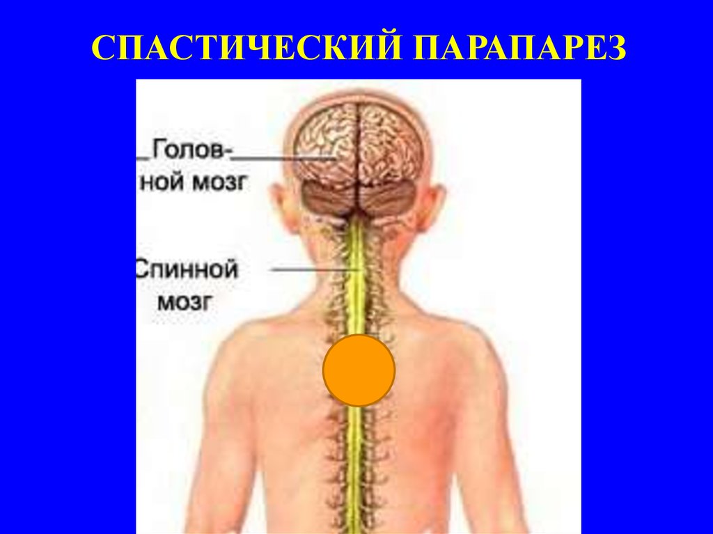 Центральный парез - презентация онлайн