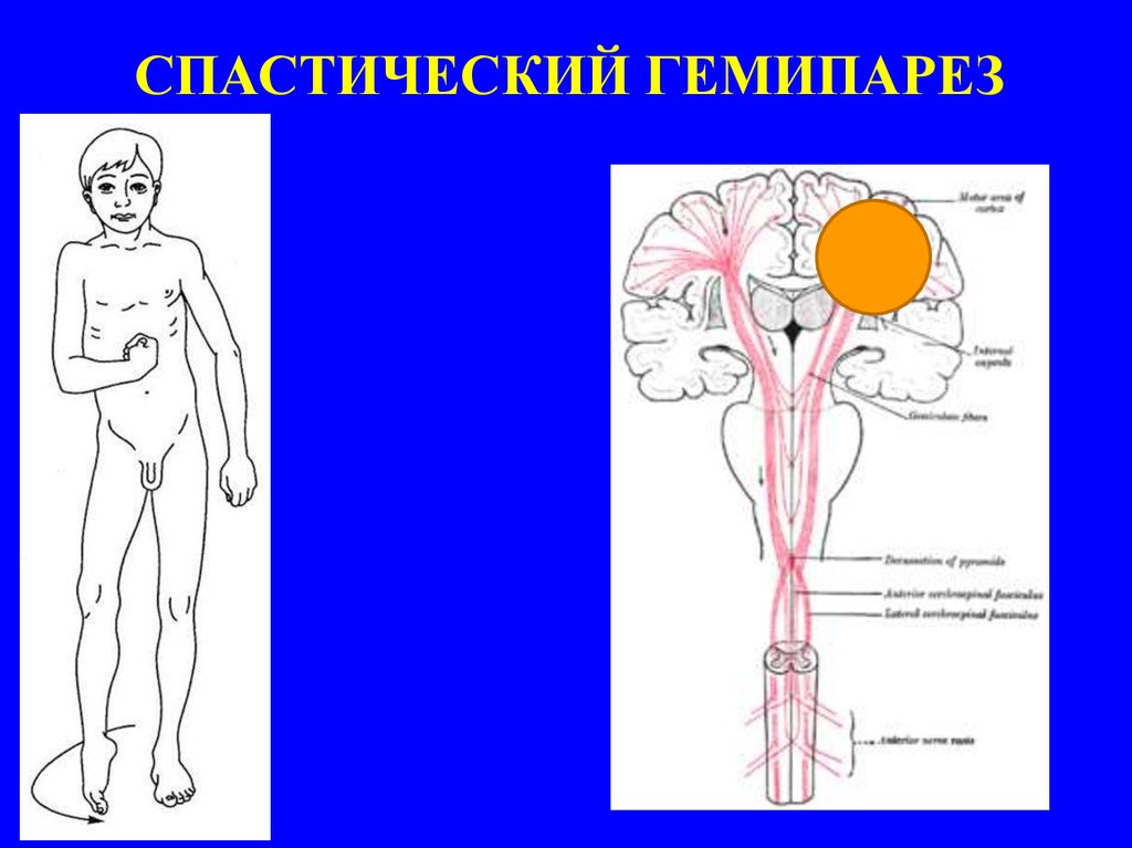 Центральный парез - презентация онлайн