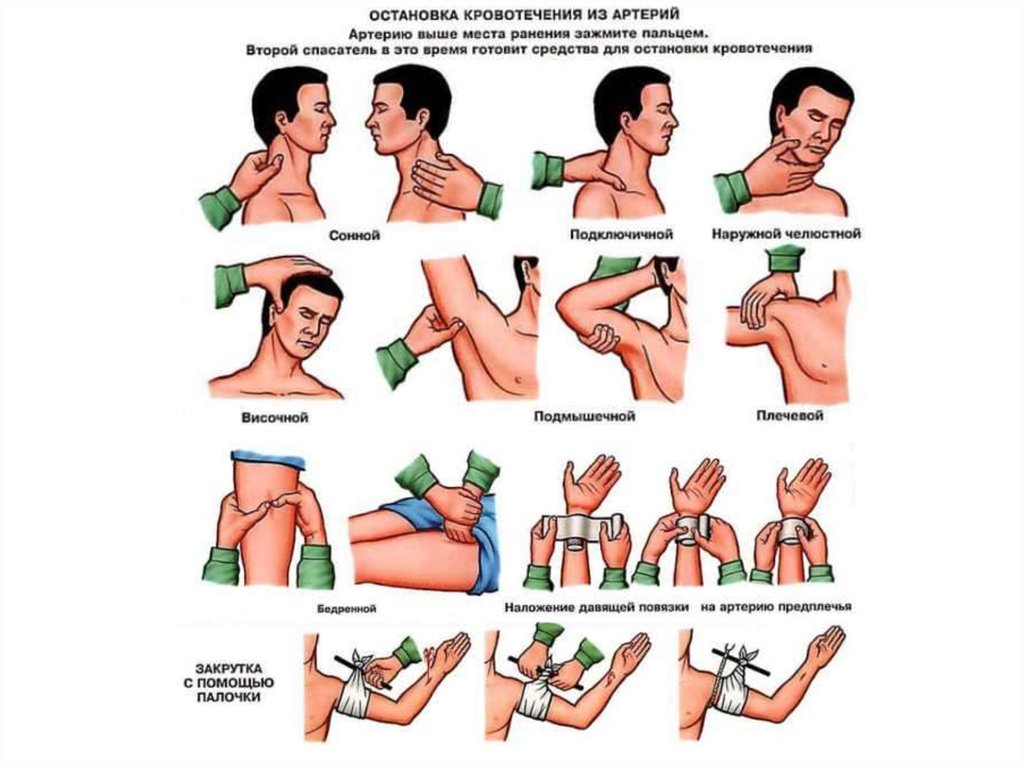 Остановка артериального кровотечения картинки
