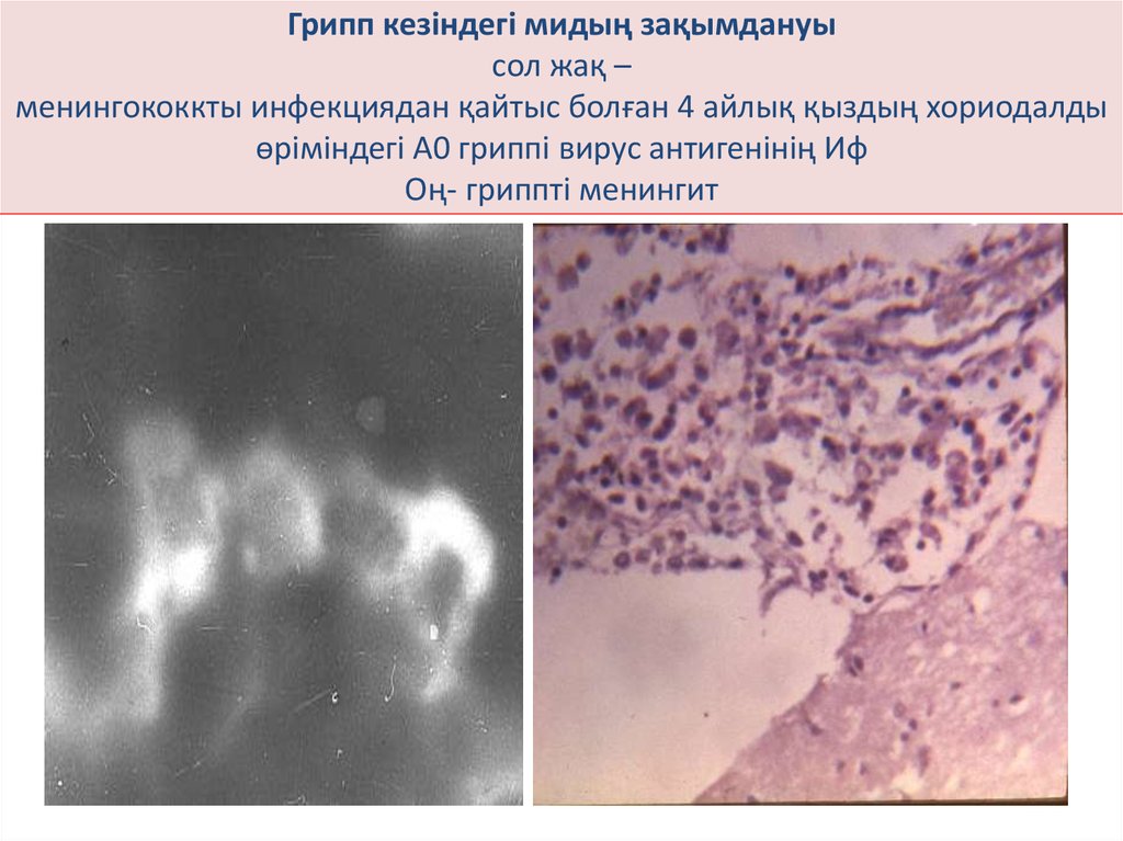 Грипп кезіндегі мидың зақымдануы сол жақ – менингококкты инфекциядан қайтыс болған 4 айлық қыздың хориодалды өріміндегі А0