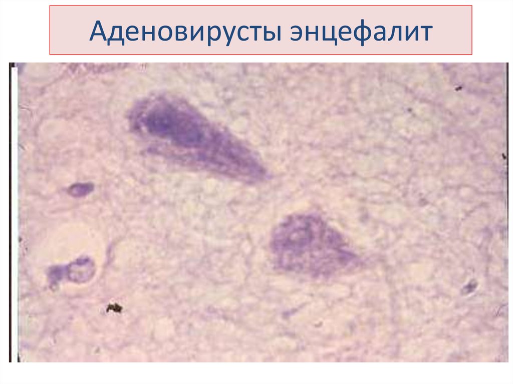Аденовирусты энцефалит