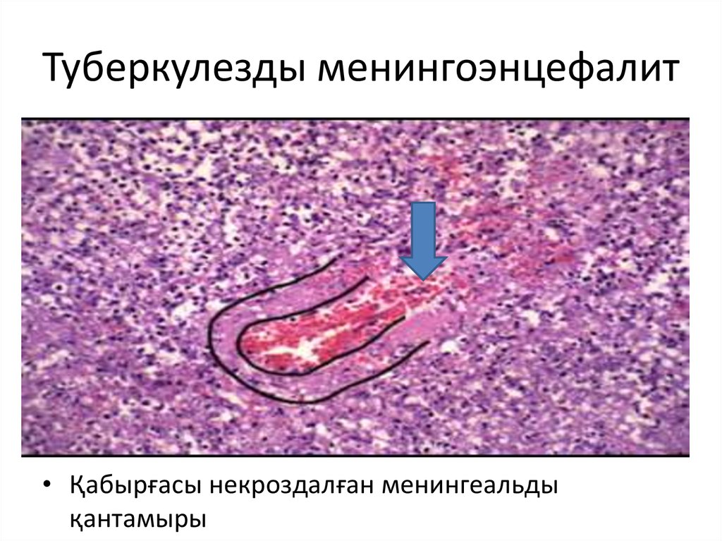 Туберкулезды менингоэнцефалит