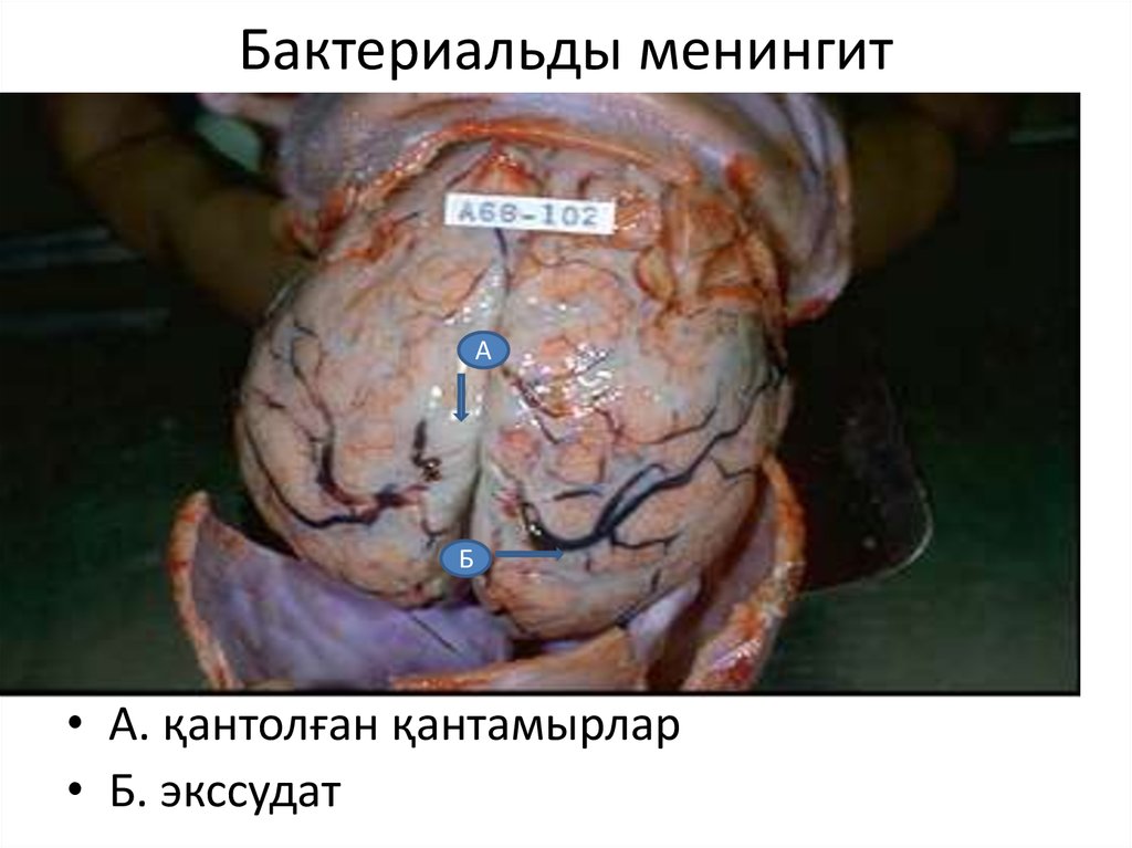 Бактериальды менингит