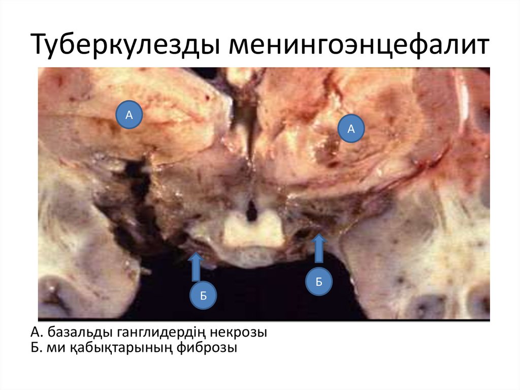 Туберкулезды менингоэнцефалит
