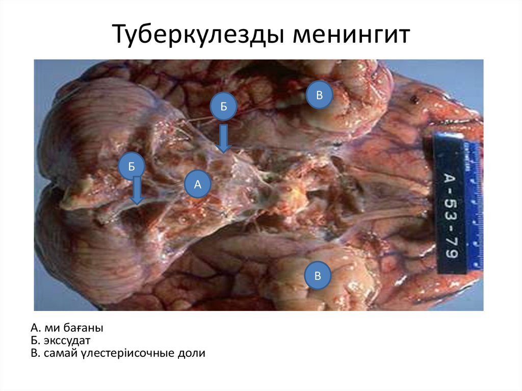 Туберкулезды менингит