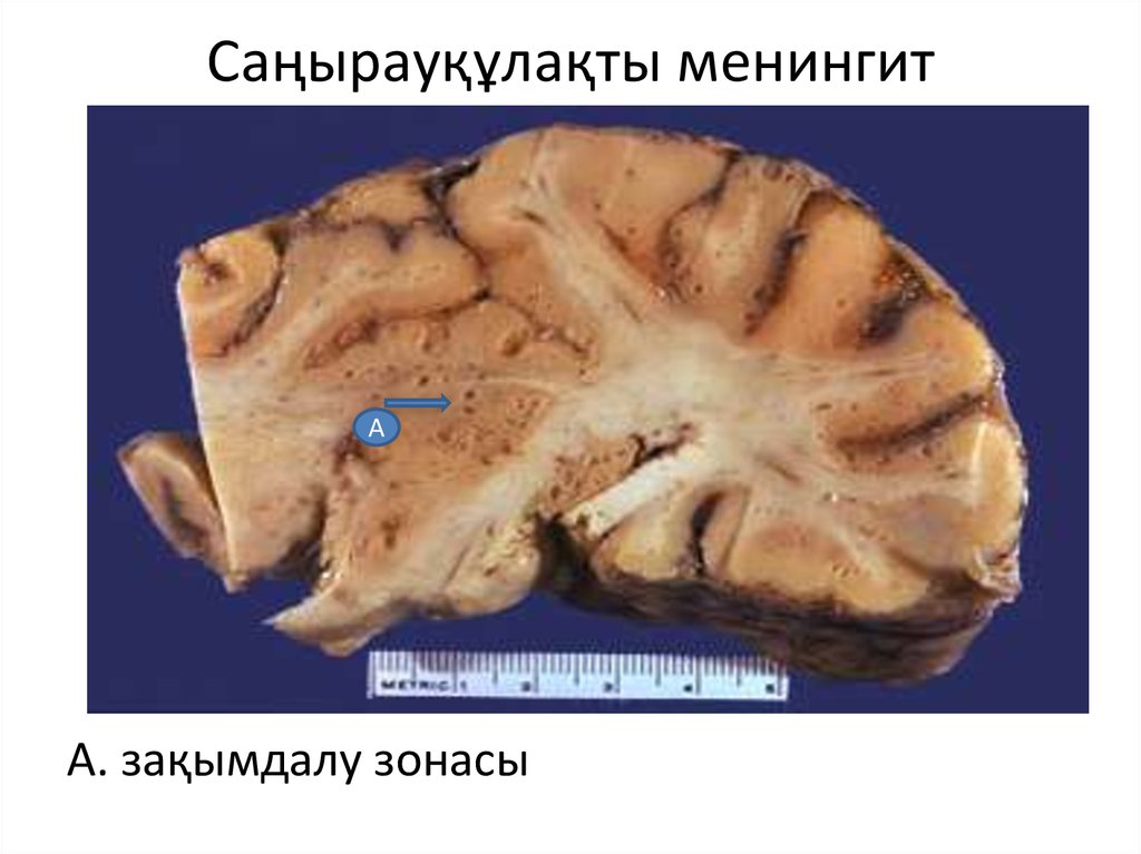 Саңырауқұлақты менингит