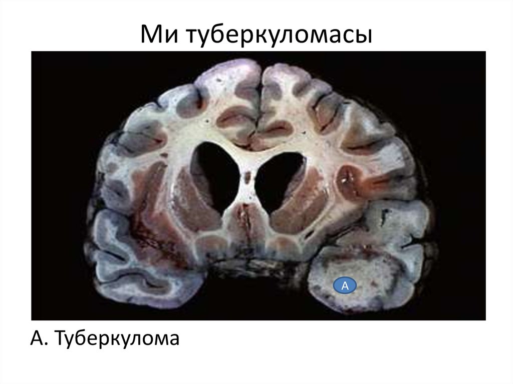 Ми туберкуломасы