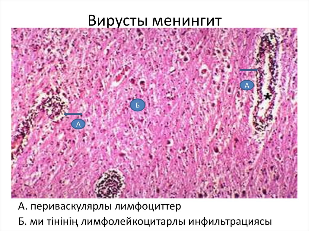 Вирусты менингит