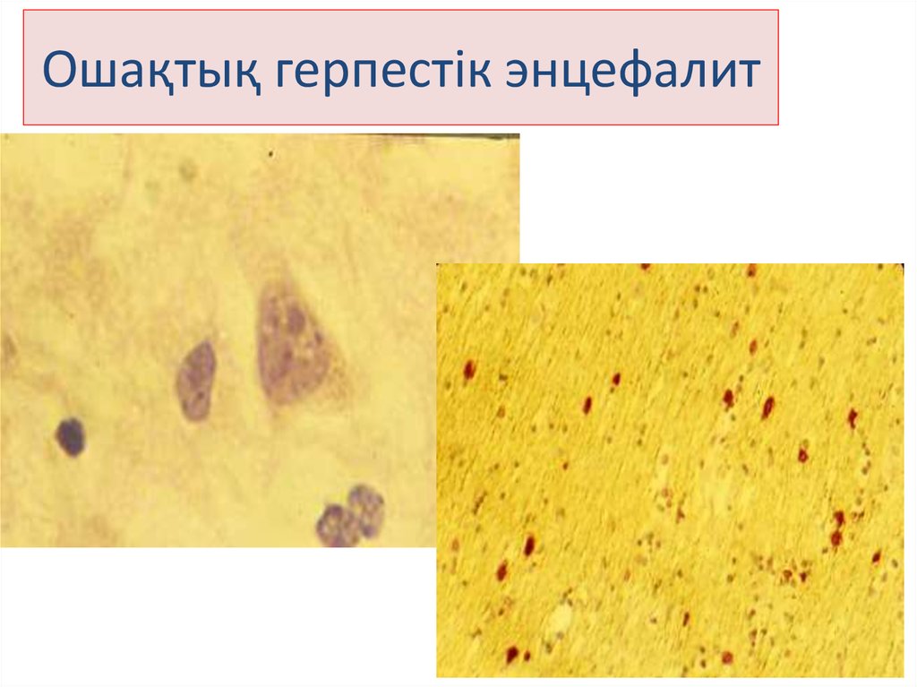 Ошақтық герпестік энцефалит