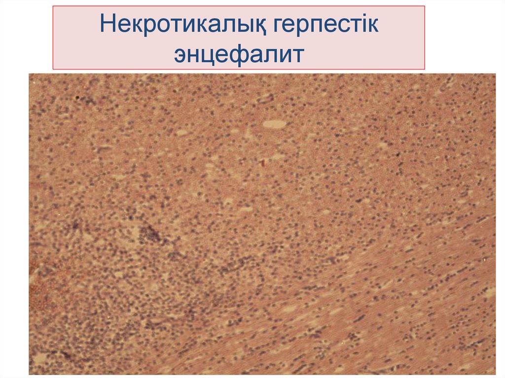 Некротикалық герпестік энцефалит