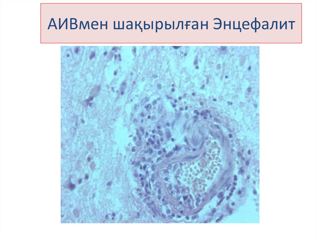 Клещевой энцефалит презентация патанатомия