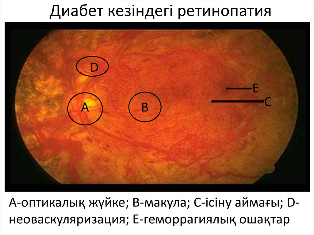 Диабетическая ретинопатия микроскопия. Диабетическая ретинопатия патогенез. Диабетическая ретинопатия неоваскуляризация.