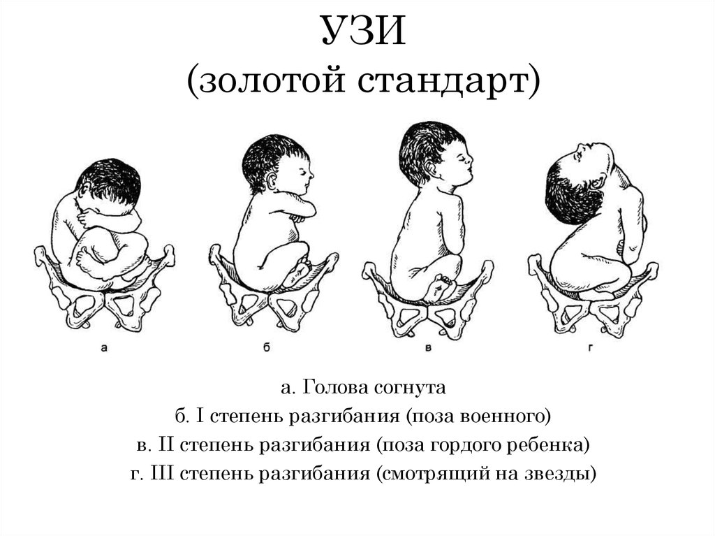 Предлежание плода картинки