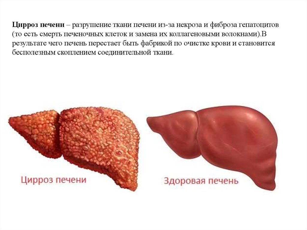 Цирроз печени - презентация онлайн