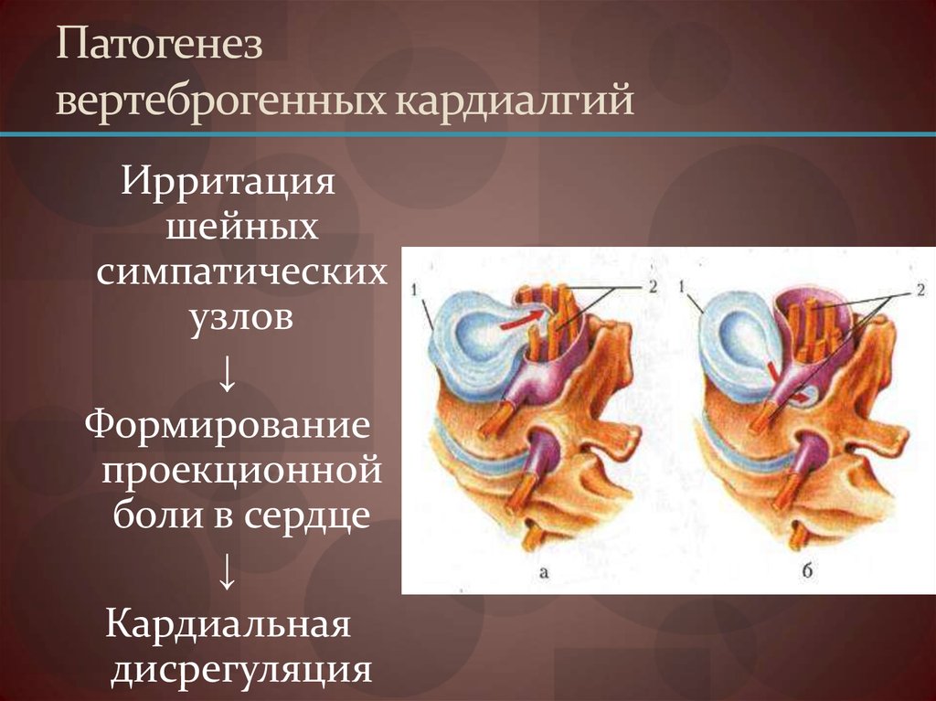 Кардиалгия. Вертеброгенная кардиалгия. Патогенез кардиалгии. Кардиалгия патогенез и этиология. Механизм возникновения кардиалгии.