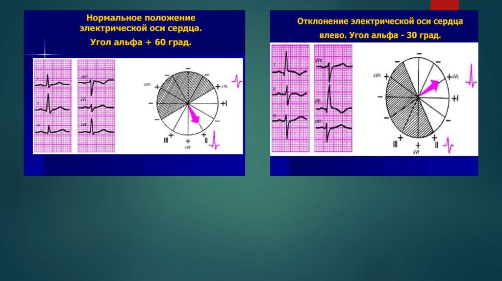 Электрическая ось. Положение электрической оси сердца. Нормальное положение ЭОС. Нормальная электрическая ось сердца. Электрическая ось вертикальная.