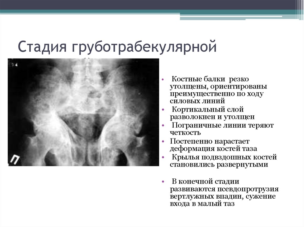 Болезнь педжета презентация