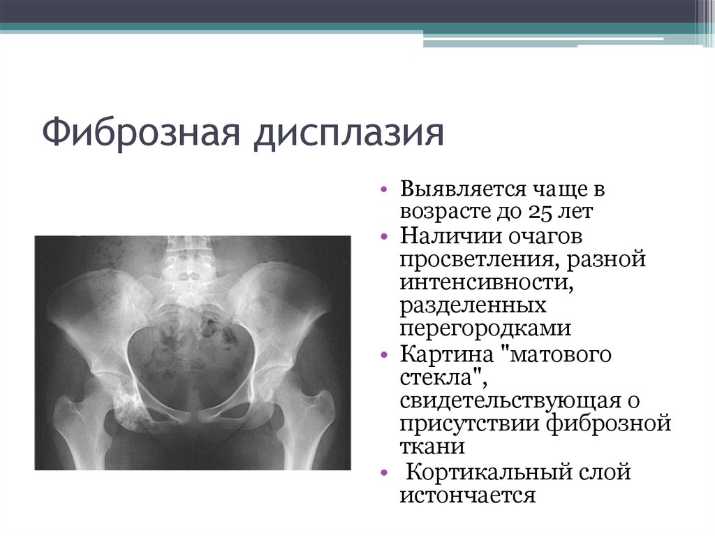 Фиброзная кость. Фиброзная дисплазия челюсти рентген. Фиброзно-кистозная дисплазия кт. Фиброзная дисплазия черепа рентген. Фиброзная дисплазия рентгенодиагностика.