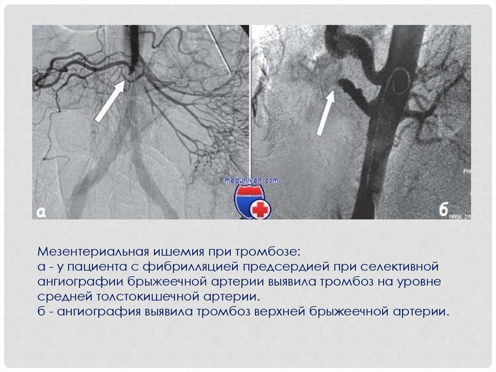 Тромбоз артерии лечение