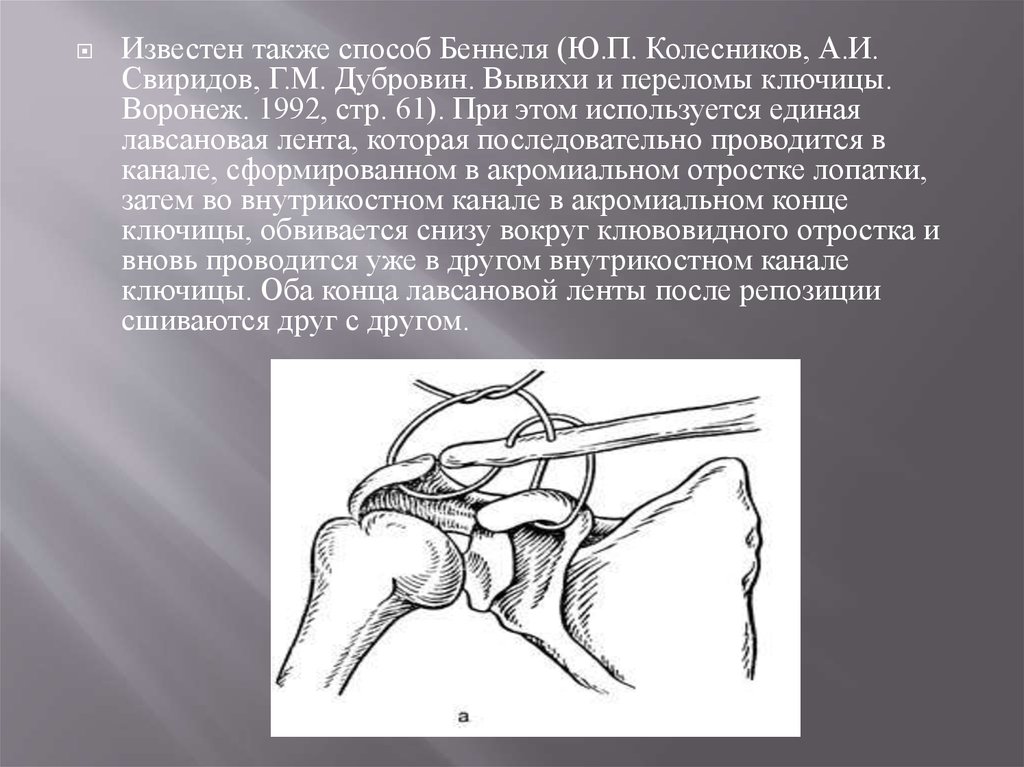 Как вправить ключицу. Пластика акромиально-ключичного сочленения по Беннелю. Остеосинтез акромиально-ключичного сочленения. Вывих акс плечевого сустава.