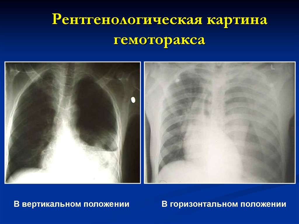 Гемоторакс клиническая картина