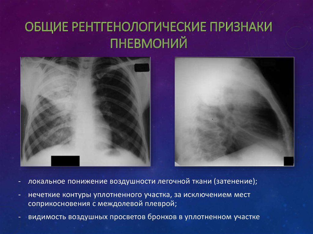 Пневмония симптомы рентген