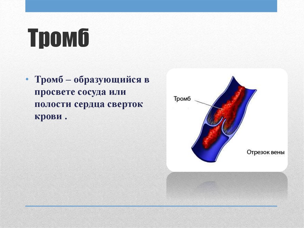 Причины тромбоза. Тромб в Просвете сосуда.