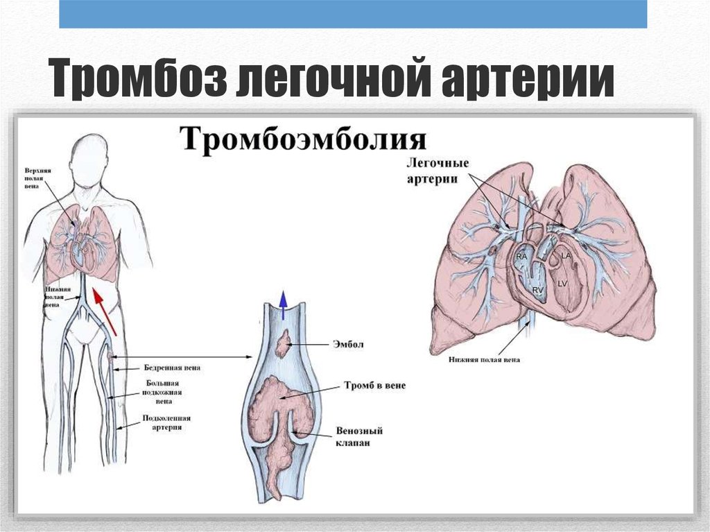 Легочный тромбоз. Тромбоэмболия ветвей легочной артерии. Тромбоэмболия легочной артерии (Тэла). Тромб легочной артерии тромбоэмболия. Источники тромбоэмболии легочной артерии.