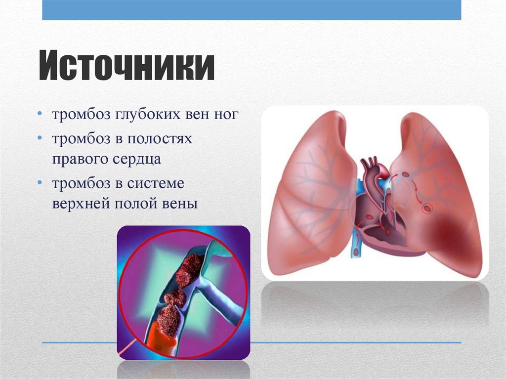 Острые тромбозы системы нижней полой вены презентация