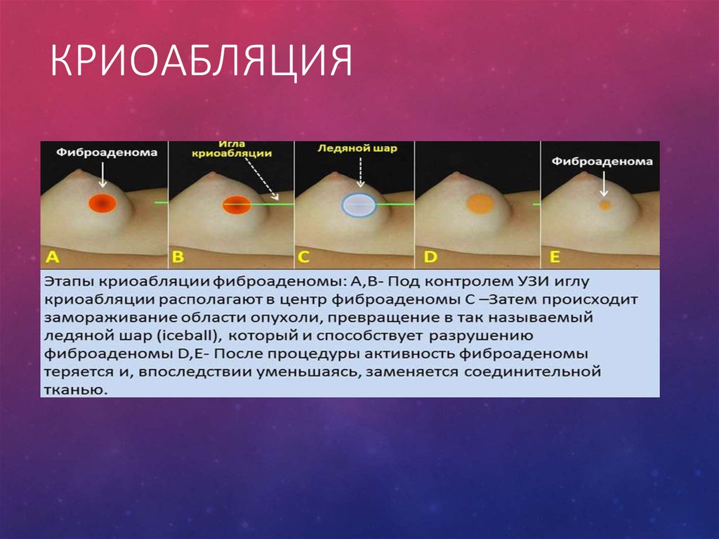 Криоабляция