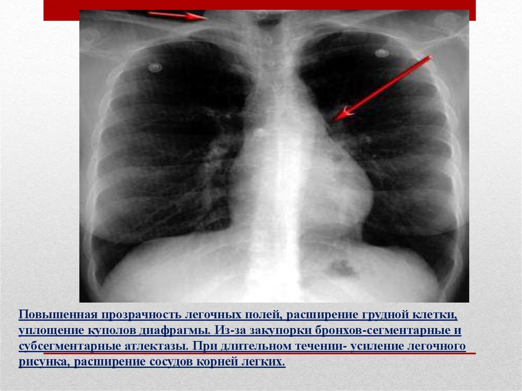Усиление легочного рисунка на рентгене