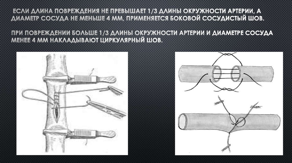 Шов артерий