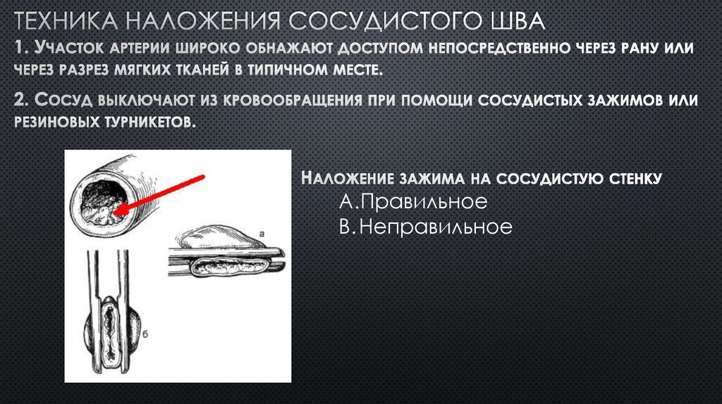 Сосудистый шов методы наложения. Методика наложения сосудистого шва. Сосудистые швы техника наложения. Инструменты для сосудистого шва.