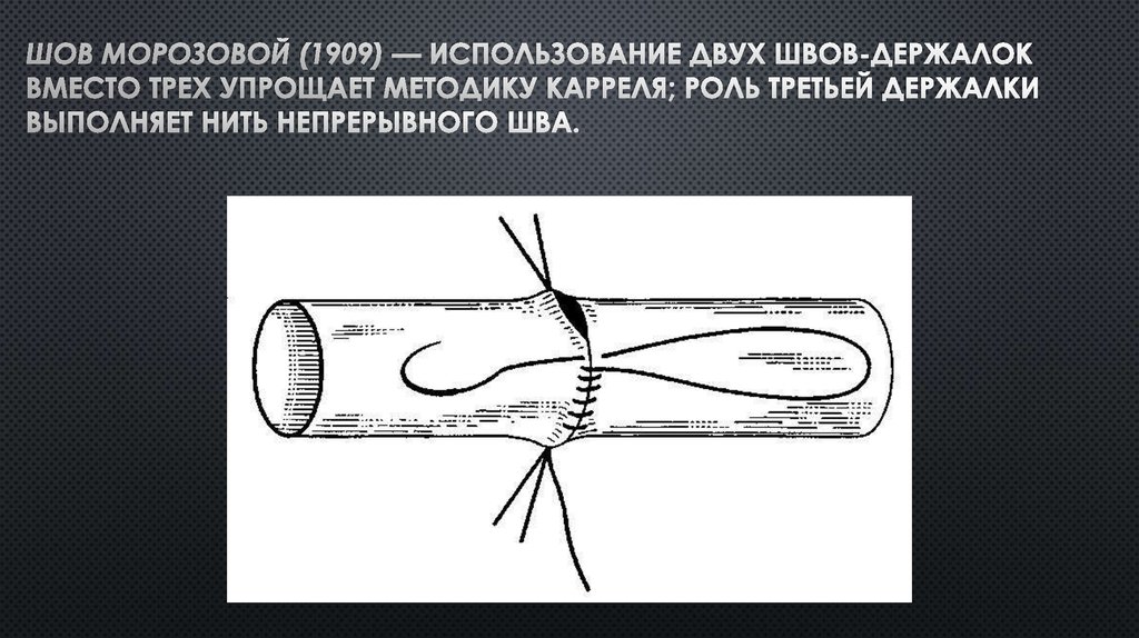 Использовала двойной. Сосудистый шов по Каррелю и Морозовой. Техника наложения сосудистого шва по Каррелю Морозовой. Сосудистый шов Карреля схема.