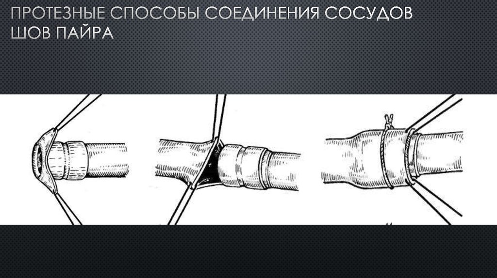 Бесшовное соединение сосудов метод а г коневского. Способы соединения сосудов. Сосудистый шов донецкого.