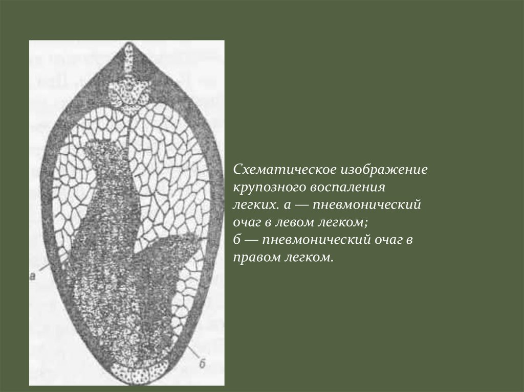 Крупозная пневмония рисунок