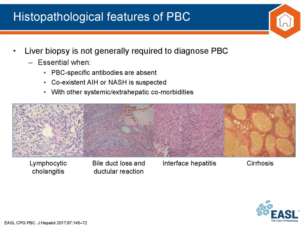 Histopathological features of PBC