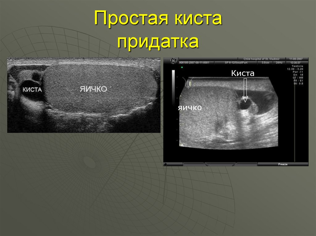 Уплотнение возле яичка. Киста придатка яичка на УЗИ. УЗИ мошонки киста придатка.