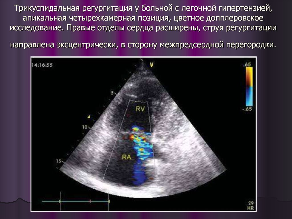 Митральная регургитация 1 степени что это значит