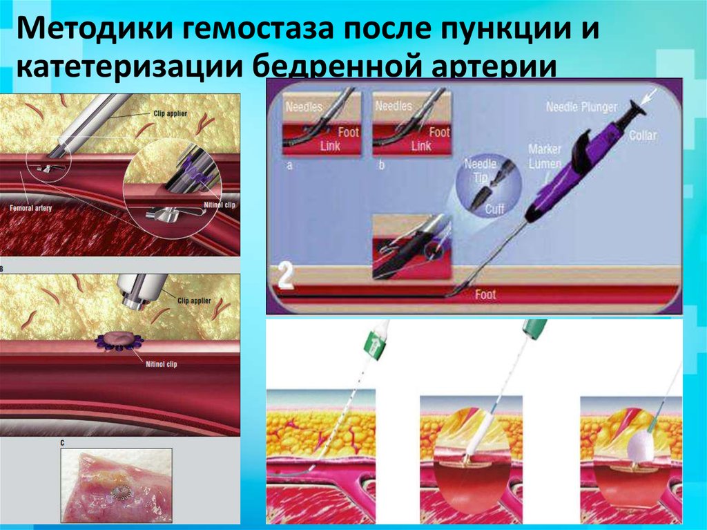 Схема по сельдингеру рентген