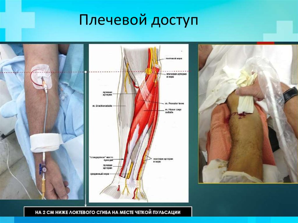 Плечевой доступ